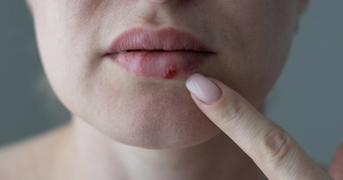 Una pastilla nueva para el herpes que se les había vuelto imposible de tratar