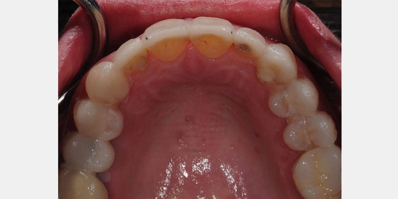 Carillas dentales: la filtración en los bordes puede comienza antes de que aparezcan dolores